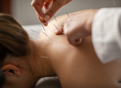Acupuncture is Now Covered by Many Insurance Plans